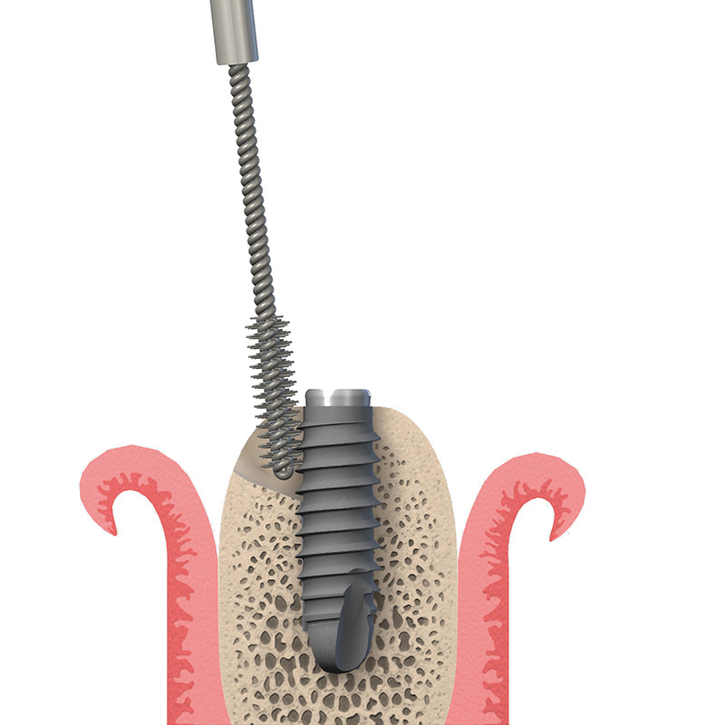 Mechanische Säuberung des Implantates mit einer speziellen Titanbürste