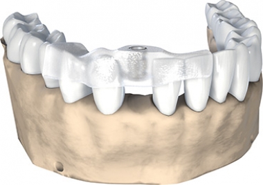 Drilling template single tooth
