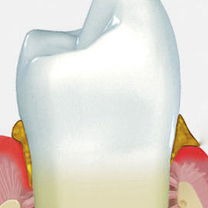 Zähne mit Plaqueanlagerung und Zahnstein. Entzündetes Zahnflewisch