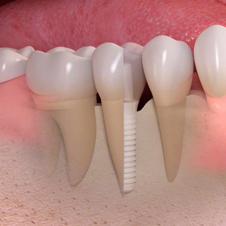 Aufbau eines keramischen Zahnimplantats