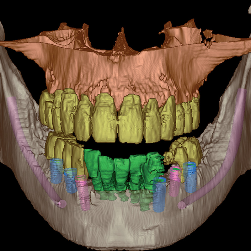 3-D-Schichtbild eines digitalen Volumentomographen für die Planung der Implantatposition