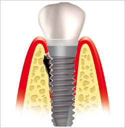 Anzeichen einer Periimplantitis sind Rötung, Blutung und Schwellung des implantatumgebenden Zahnfleisches