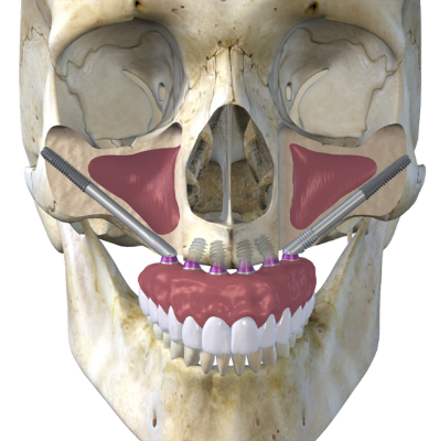 Kombination von Zygoma Implantaten mit klassischen Implantaten in der Oberkieferfront.
