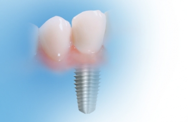 Tek diş implantı