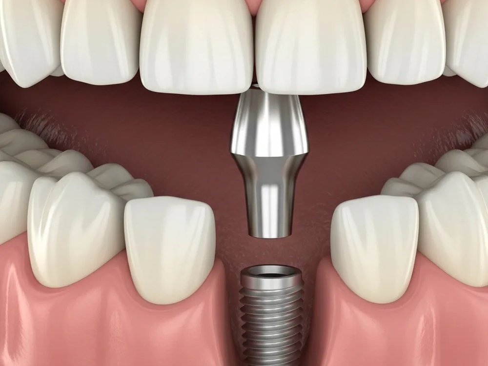 Three-dimensional view of an implant screw with abutment