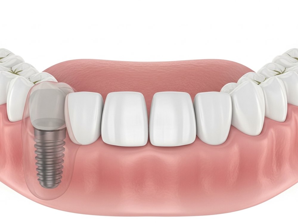 Schematic view of a healed implant in the jawbone