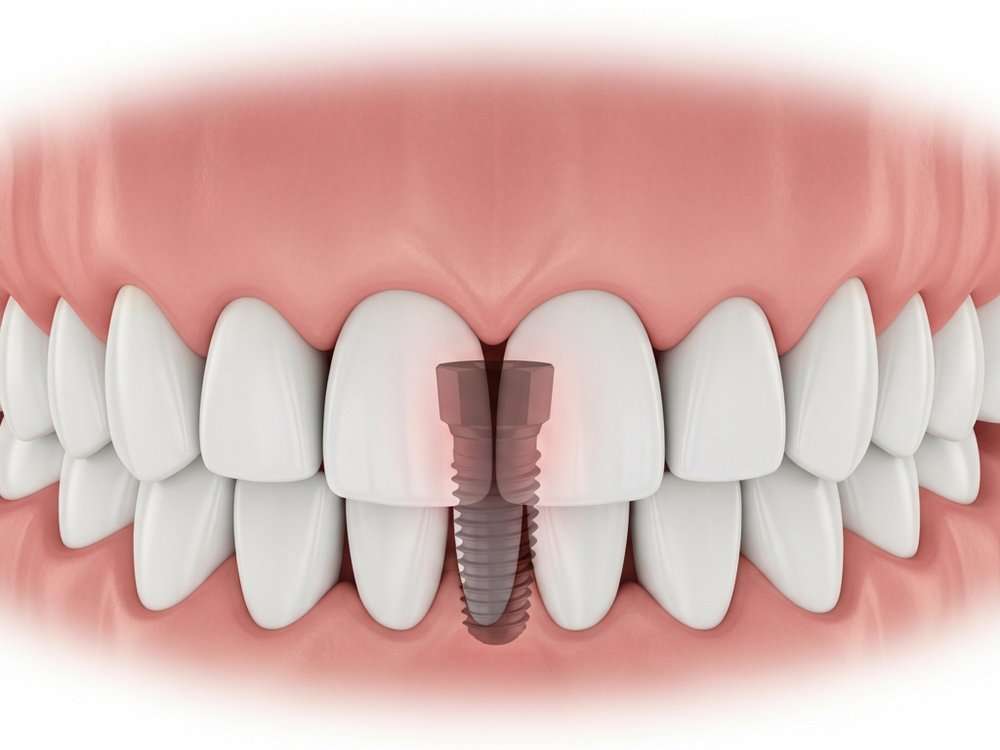 Schematic view of a healed implant in the jawbone