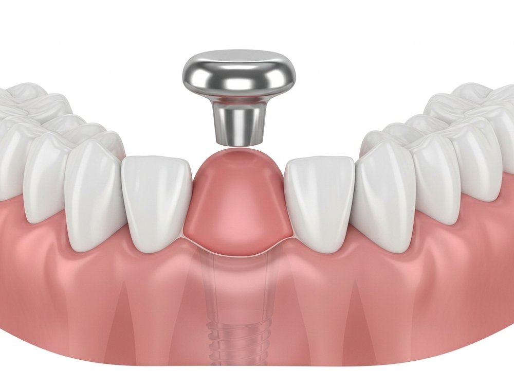 Schematic view of an implant with a healing cap in the upper jaw