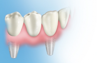 Kısmi dişsizlikte implant