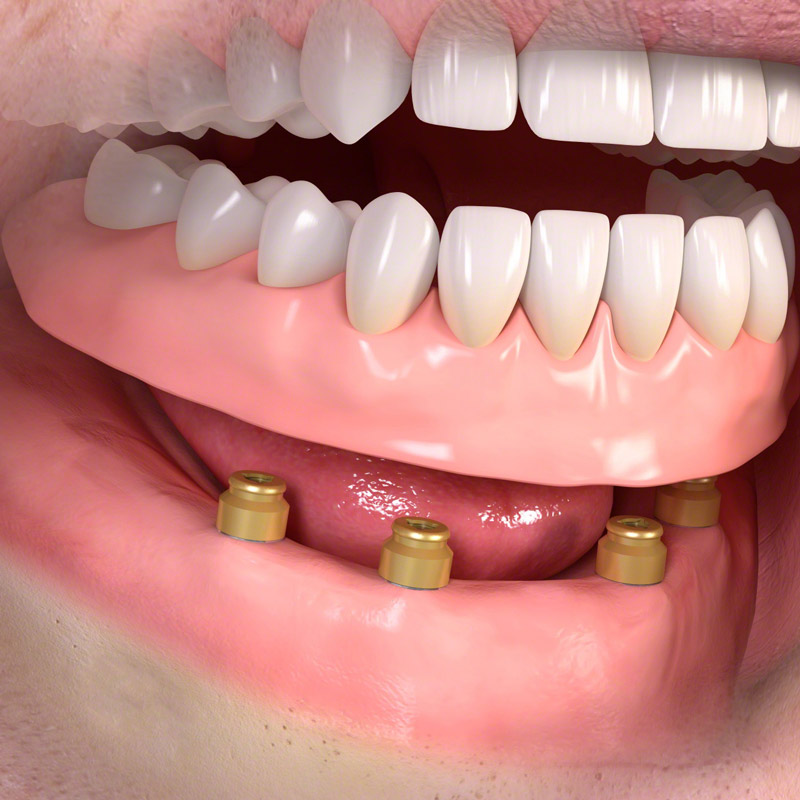 Vollprothese für Ober- und Unterkiefer