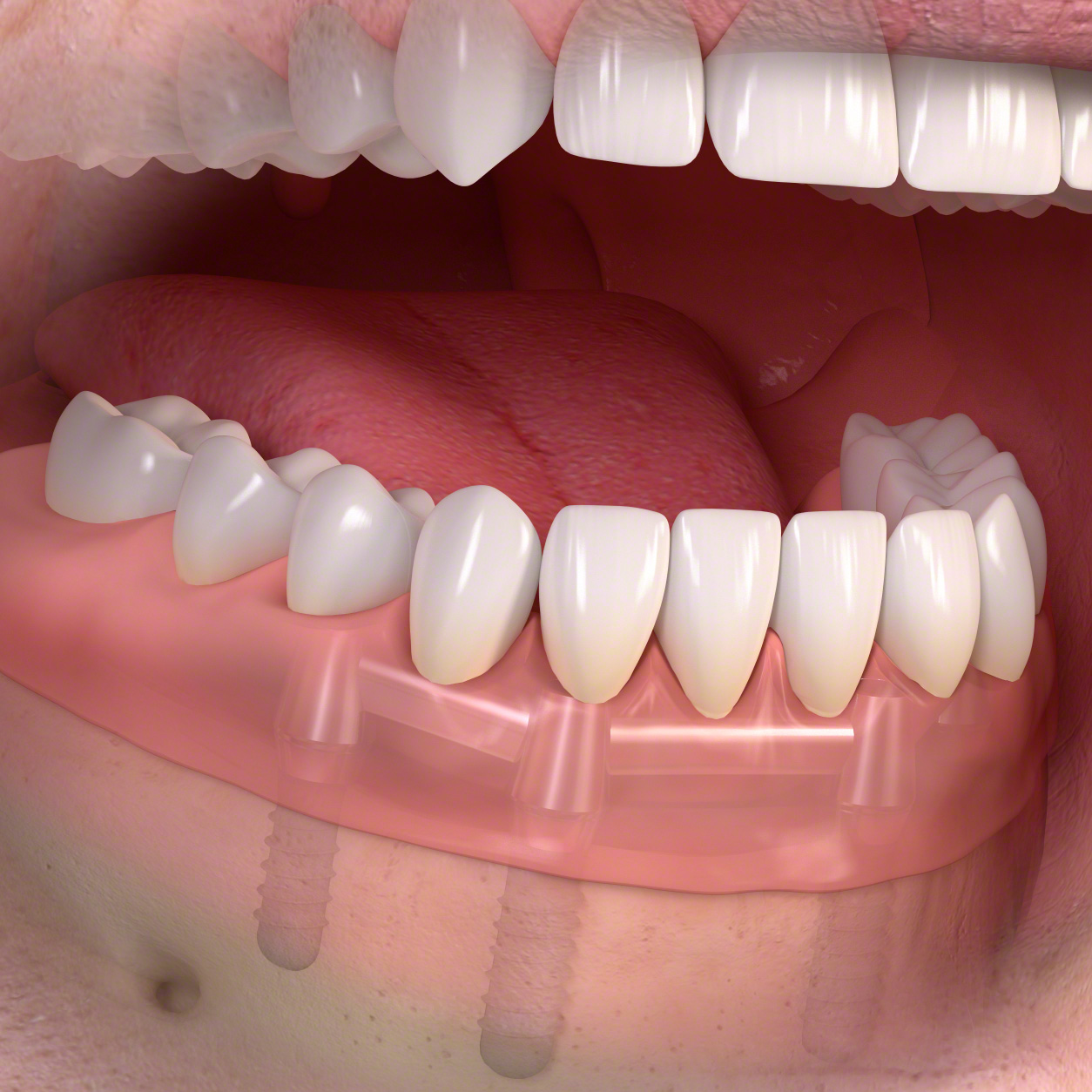 Stegkonstruktion auf vier Implantaten im Unterkiefer
