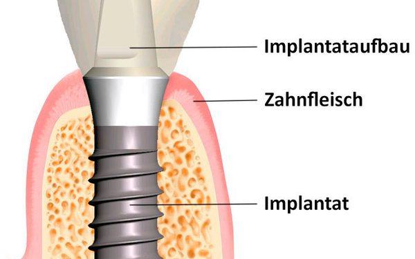 Aufbau eines Zahnimplantats mit Schraube, Aufbauteil und Krone