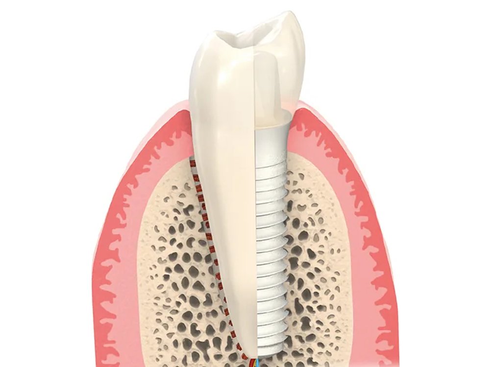 Cross-section through a ceramic implant in the jawbone