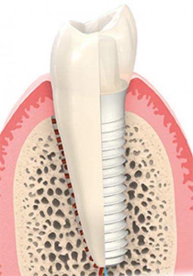 Seramik implant