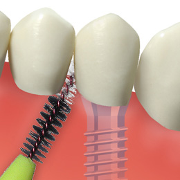 Implantat im umgebenden Gewebe