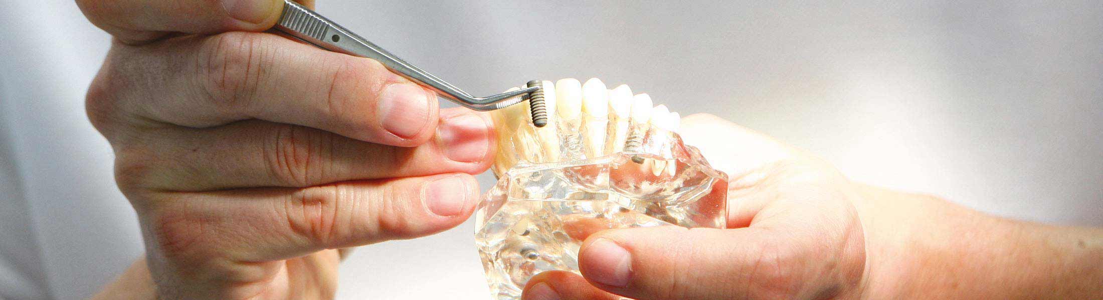 Zahnimplantate: Individuelle Lösungen bei Zahnverlust