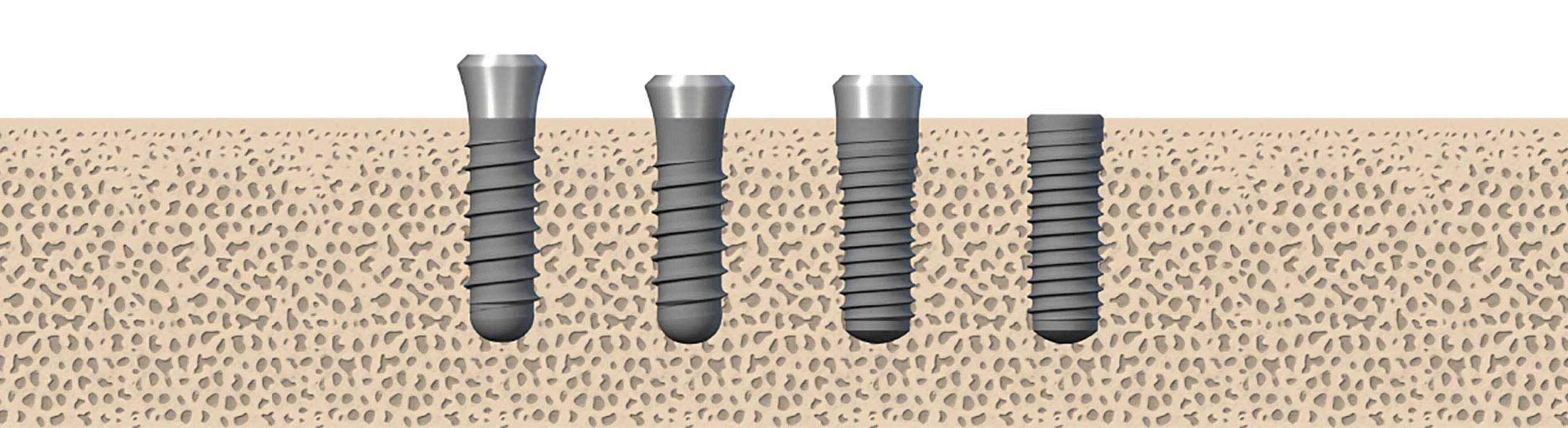 Implantsysteme und Implantatformen