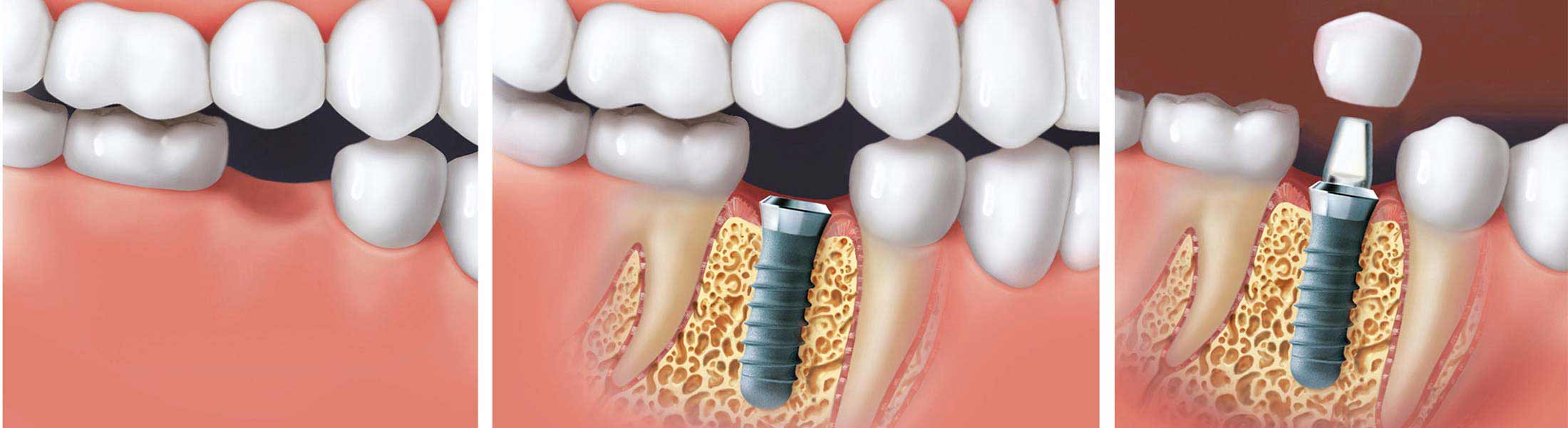 Implantat mit Aufbau wird in die Zahnlücke eingesetzt, schematisch