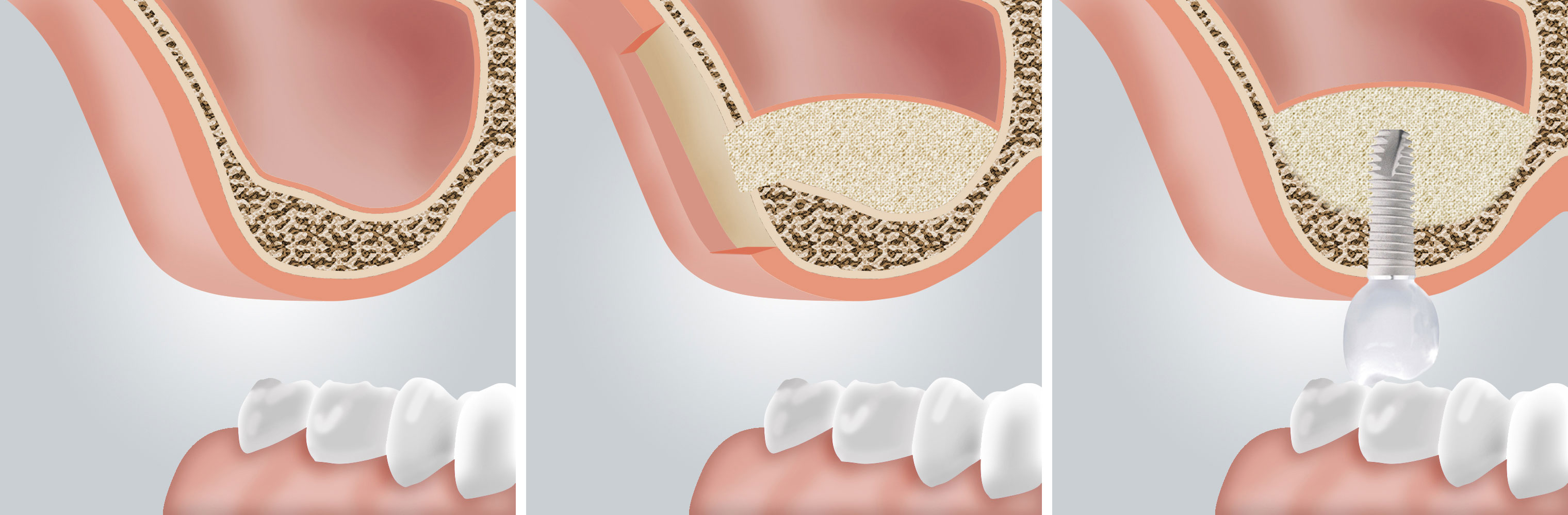 Mit einem Sinuslift wird der sichere Halt des Zahnimplantats gewährleistet